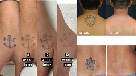 Before And After Tattoo Removal Woman Before And After Laser Tattoo Before And After Tattoo Removal Woman Before And After Laser Tattoo