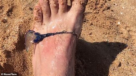 Curious Man Stings Himself On The Foot With A Blue Bottle Twice To Test
