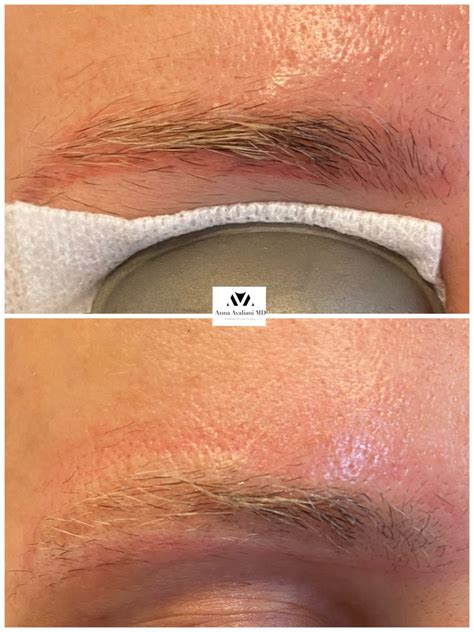 Gallery Tattoo Eyebrow Removal Anna Avaliani Md Cosmetic Amp Laser