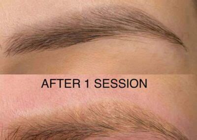 Laser Eyebrow Tattoo Removal Richmond Hill Toronto Ontario