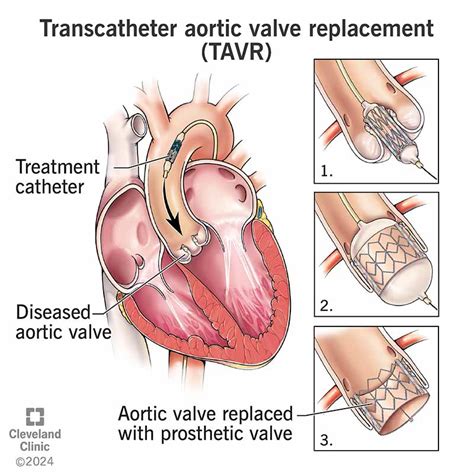 Orlando Health Tavr Procedure