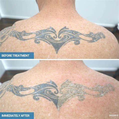 Tattoo Removal Before And After Goodbye Tattoos Sydney Tattoo Removal Before And After Goodbye Tattoos Sydney