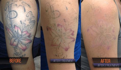 Tattoo Removal Results In Round Rock Tx Clean Slate Ink Tattoo Removal Results In Round Rock Tx Clean Slate Ink
